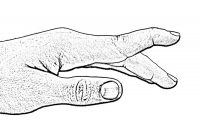 Hyperextension hand graphic