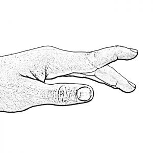 Hyperextension hand graphic