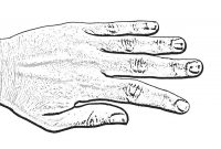 Lateral Instability hand graphic