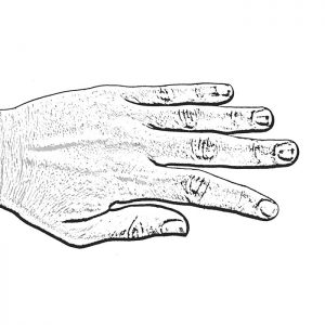 Lateral Instability hand graphic